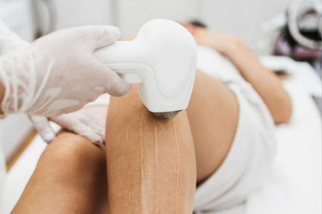 RF skin tightening in Melbourne