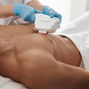 Laser Hair Removal vs Waxing